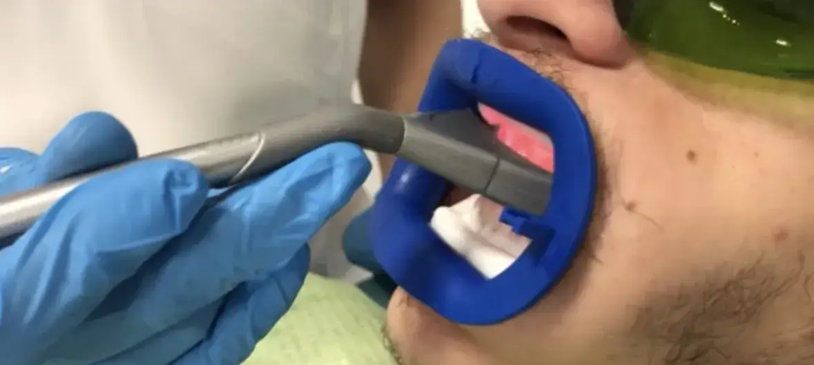 Albire dentară cu laser Bucuresti