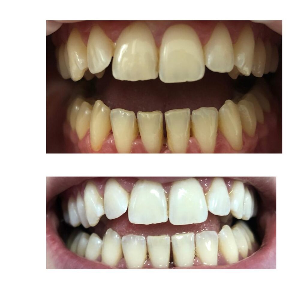 albire dentara laser